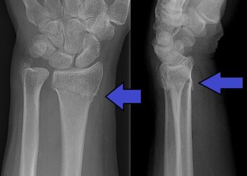 Ziekenhuizen houden rekening met flinke toename van botbreuken en kneuzingen